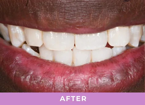 Smile with dental implant