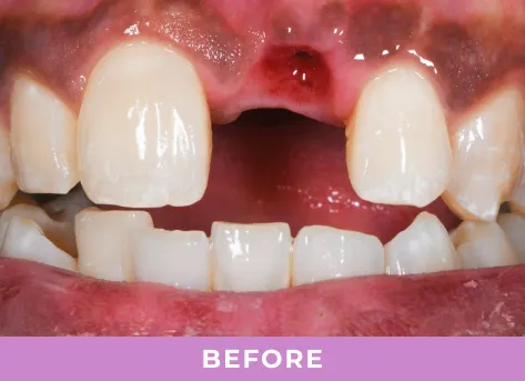 Missing tooth before dental implant